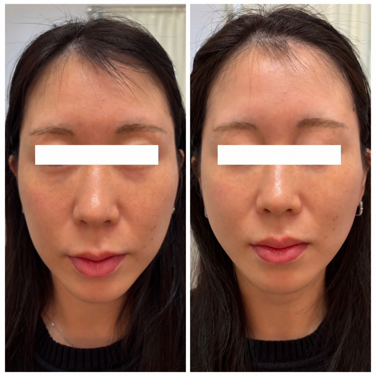 UKICLINIC 糸リフト ショート10本 症例05 施術直前と施術直後