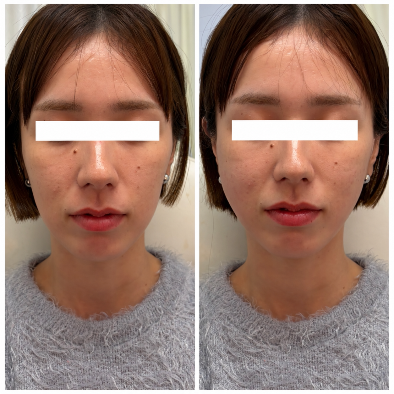 UKICLINIC 糸リフト ショート10本 症例04 施術直前と施術直後