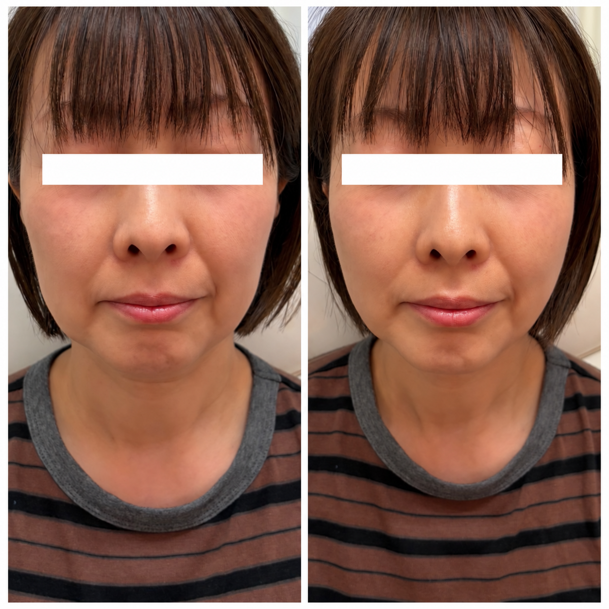 UKICLINIC 糸リフト ショート10本 症例03 施術直前と施術直後
