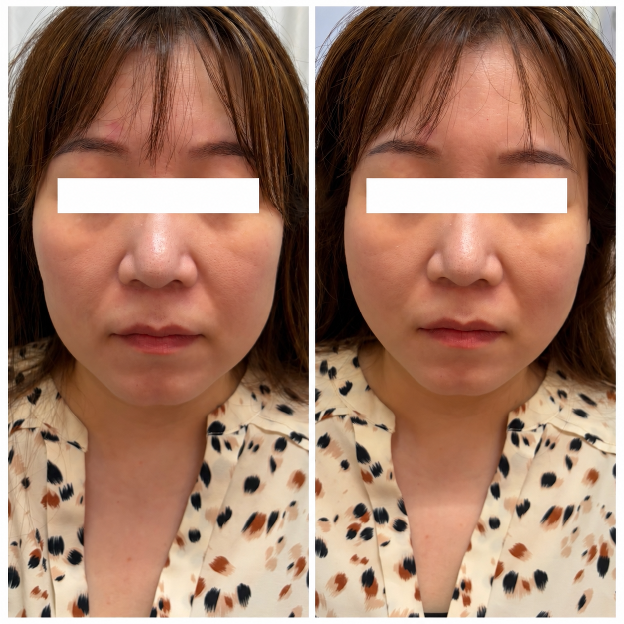 UKICLINIC 糸リフト ショート10本 症例02 施術直前と施術直後