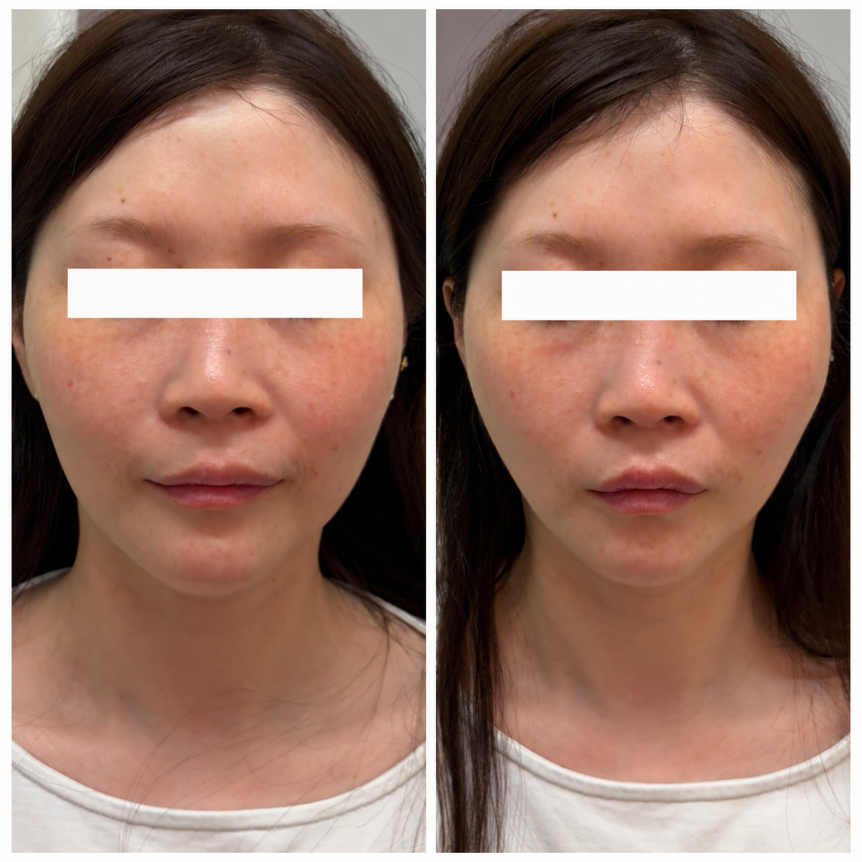 UKICLINIC 糸リフト ショート10本 症例01 施術直前と施術直後